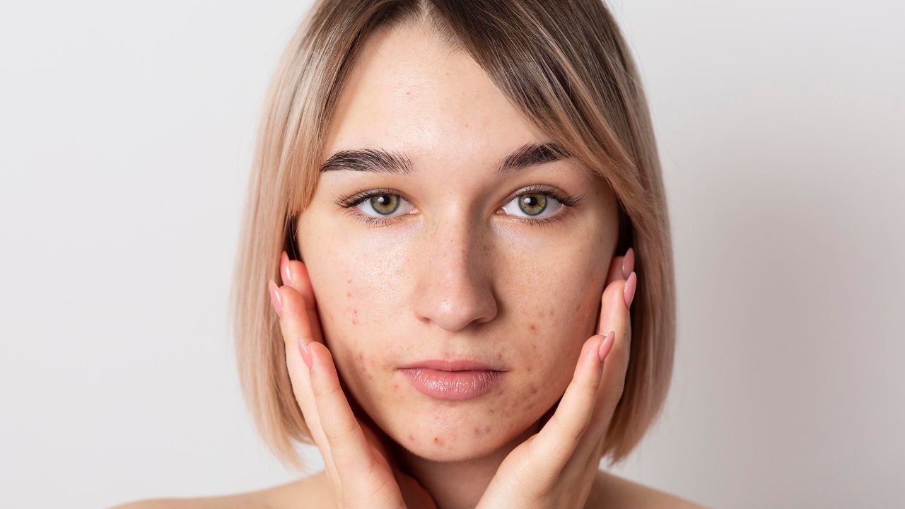 Como acabar com espinhas