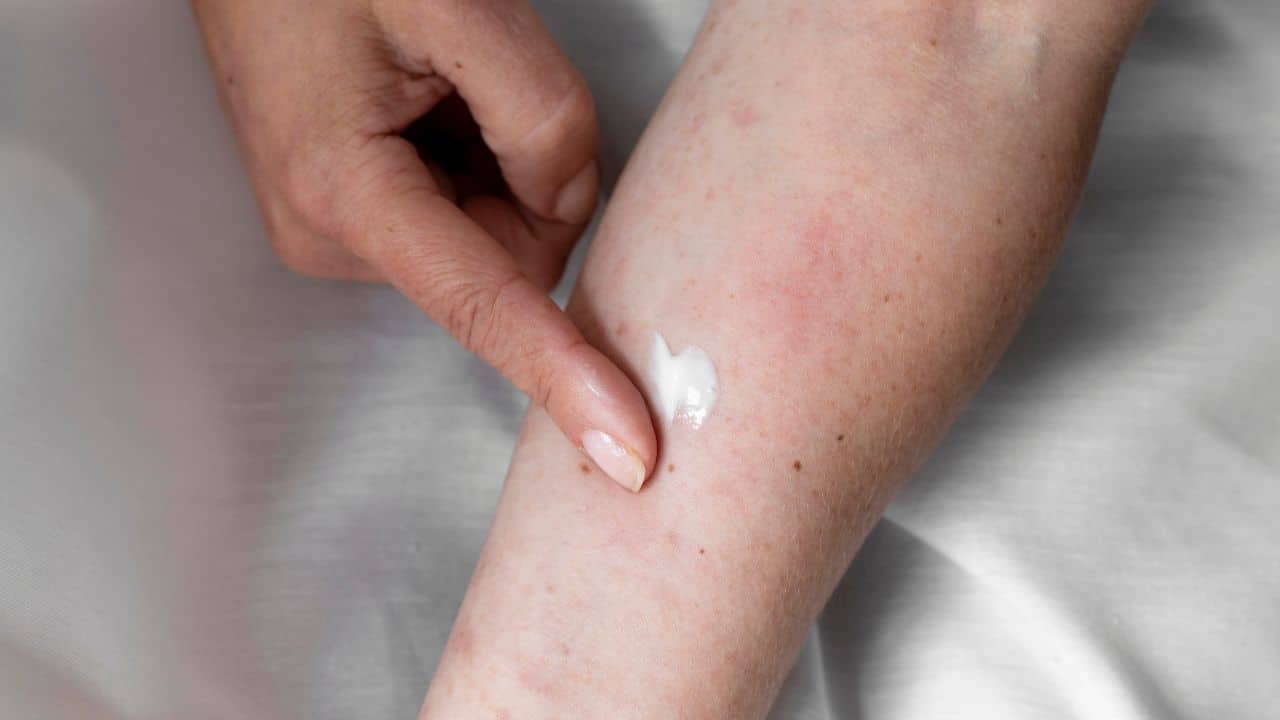 Causas mais comuns da micose de praia Causas mais comuns da micose de praia