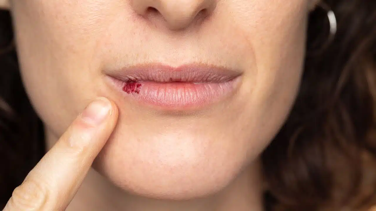 Tipos de ferida na boca e como identificar Tipos de ferida na boca e como identificar