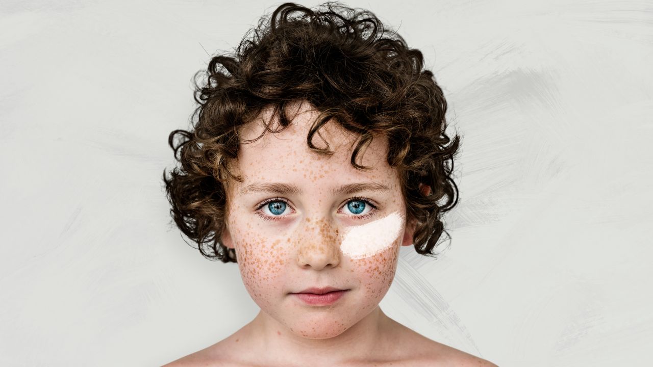 Causas comuns de mancha branca no rosto de criança Causas comuns de mancha branca no rosto de criança