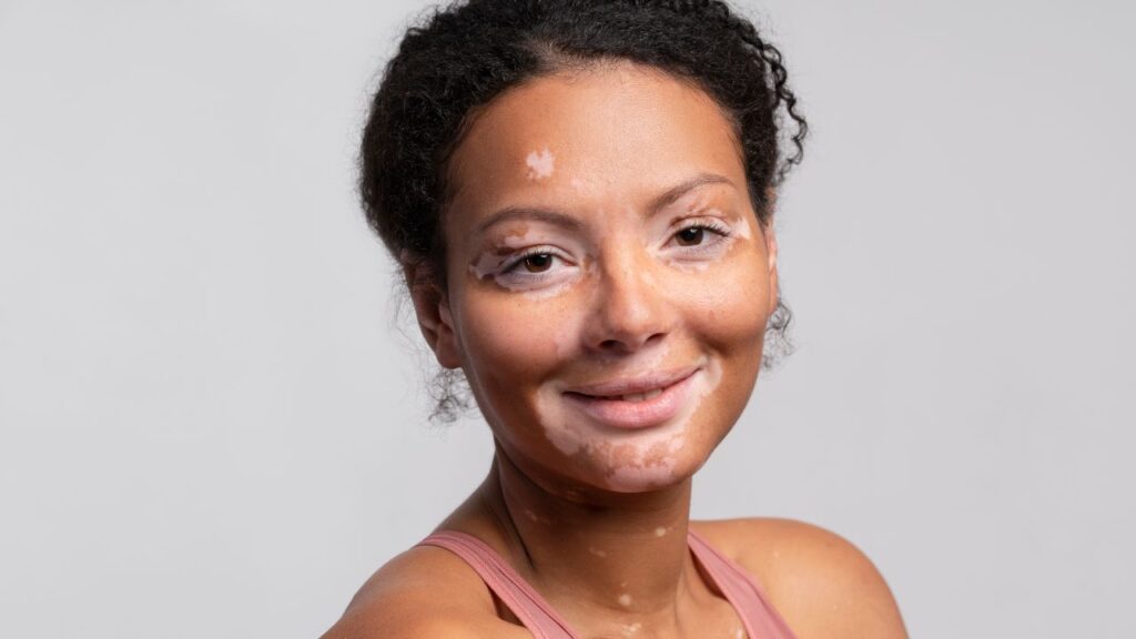 mancha branca no rosto de criança