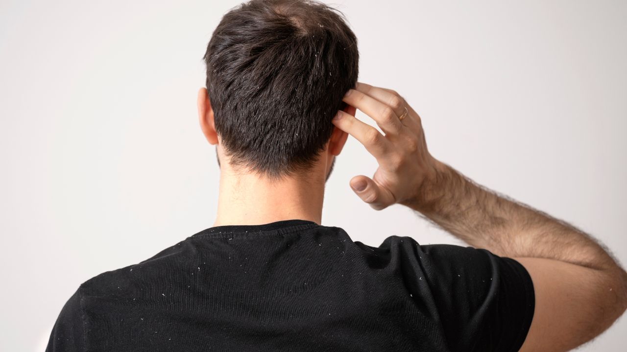 Quando procurar um dermatologista para caspa Quando procurar um dermatologista para caspa