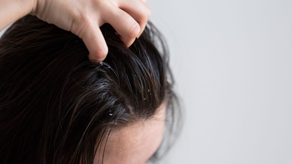 Seborreia no couro cabeludo