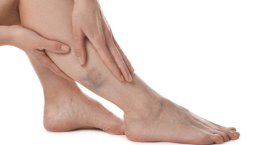 Varizes nas pernas como tratar