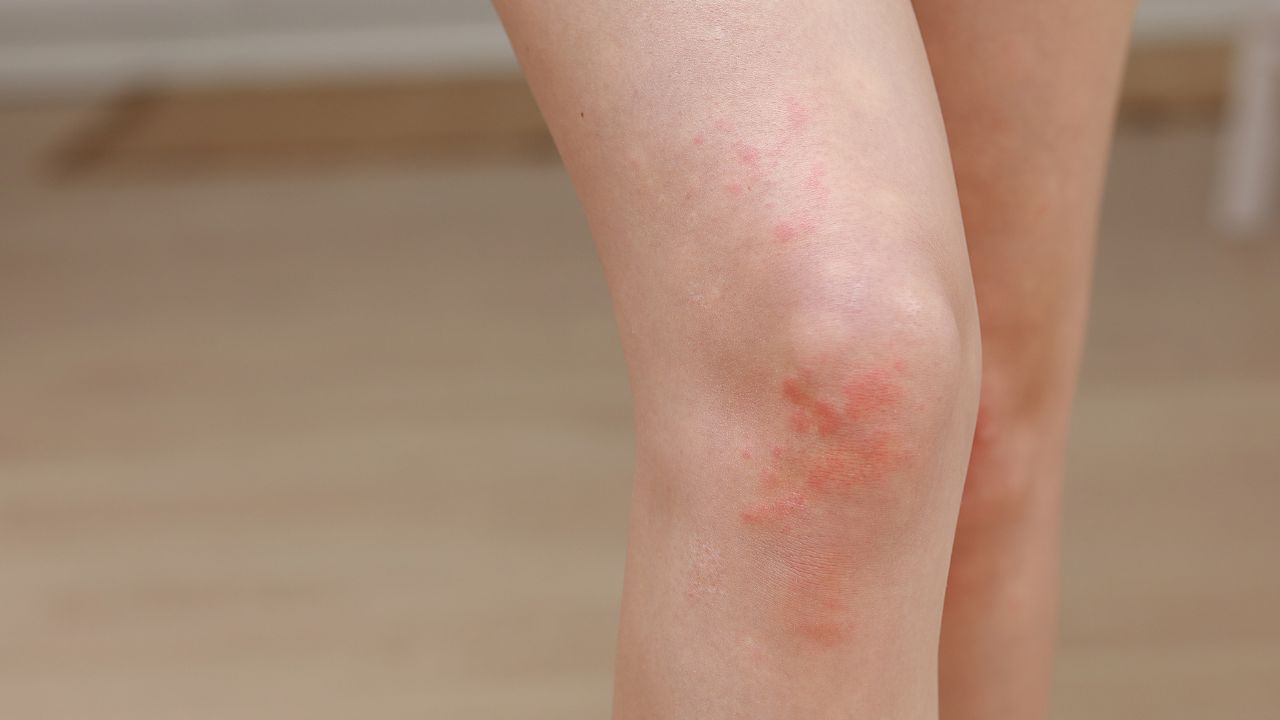 bolinha na perna bolinha na perna