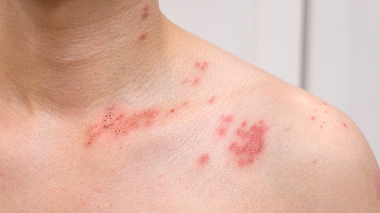 bolinhas na pele que coçam bolinhas na pele que coçam
