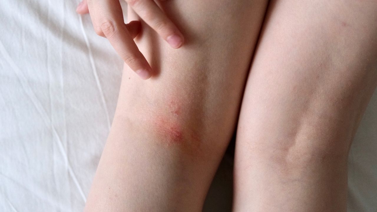 bolinhas na perna bolinhas na perna