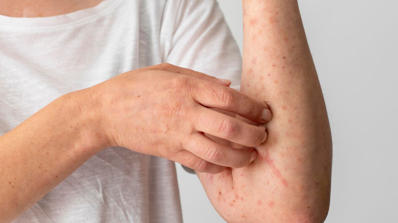 catapora em adulto catapora em adulto