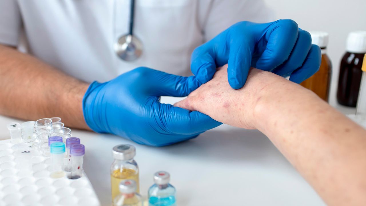 catapora inicio catapora inicio