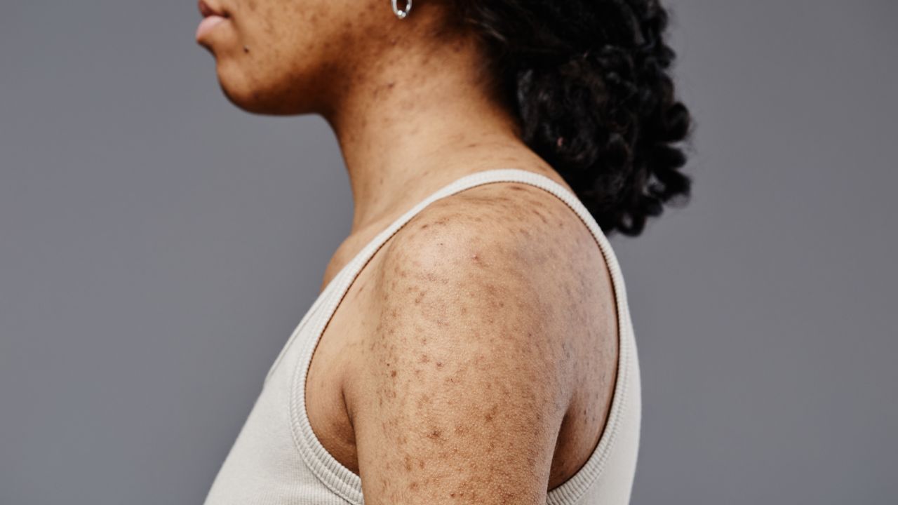 ceratose pilar tratamento ceratose pilar tratamento