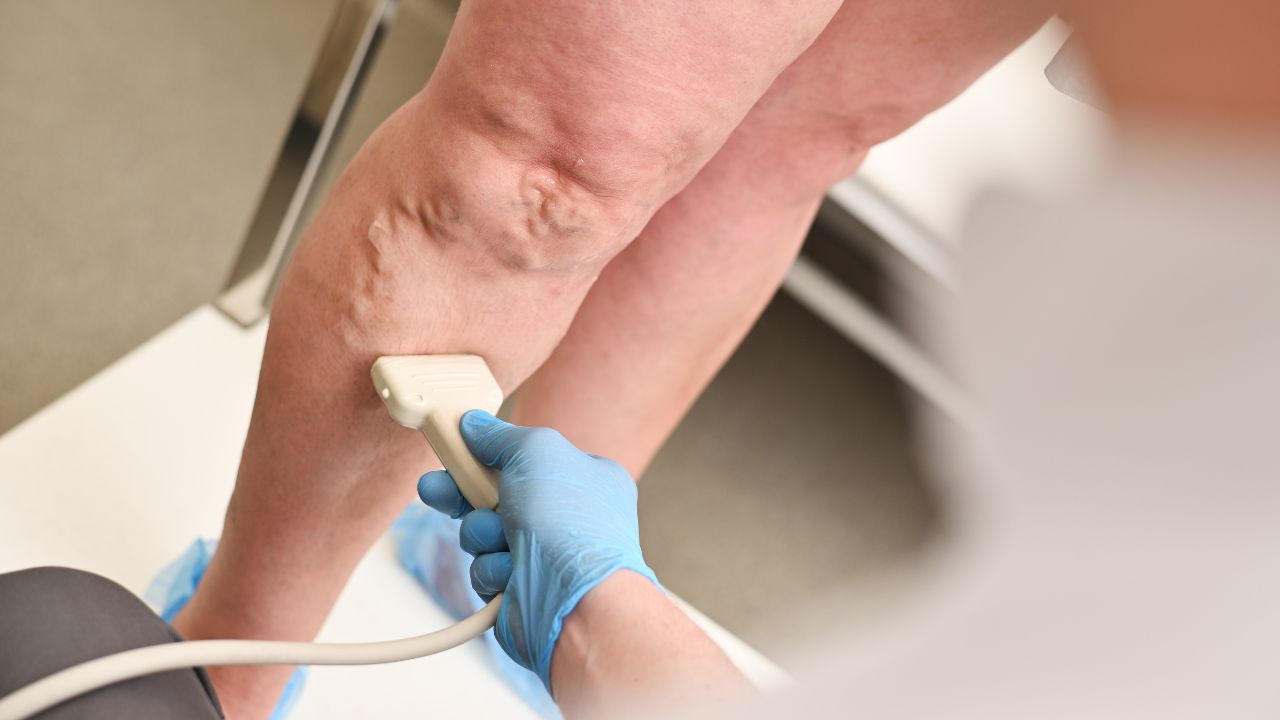 como evitar varizes nas pernas como evitar varizes nas pernas