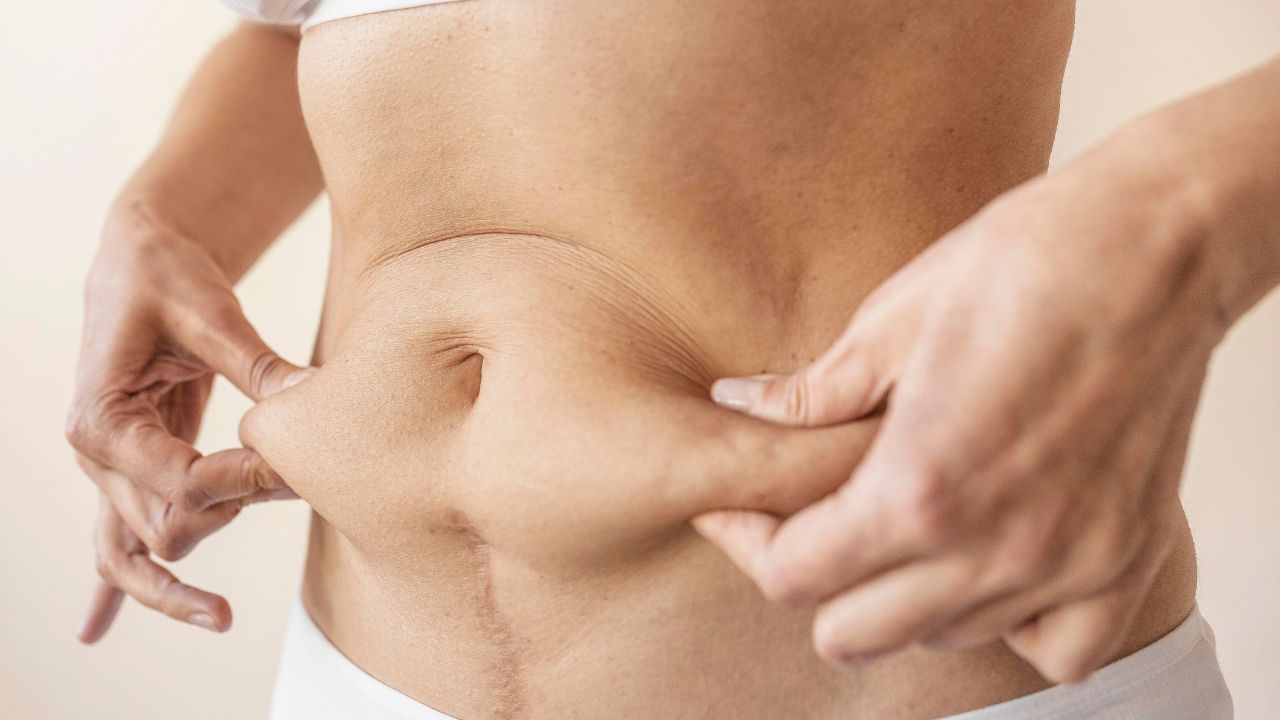 O que é diástase abdominal O que é diástase abdominal