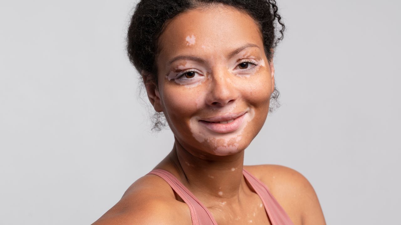 Perguntas Frequentes sobre mancha Branca na Pele Perguntas Frequentes sobre mancha Branca na Pele