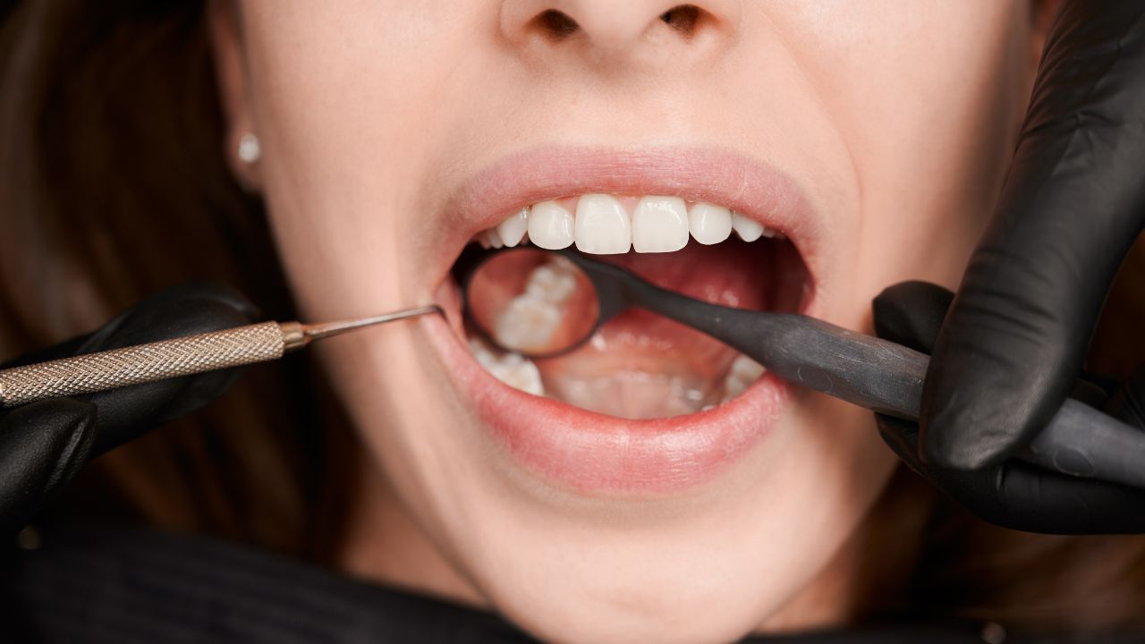 Quem tem mais risco de desenvolver cárie Quem tem mais risco de desenvolver cárie