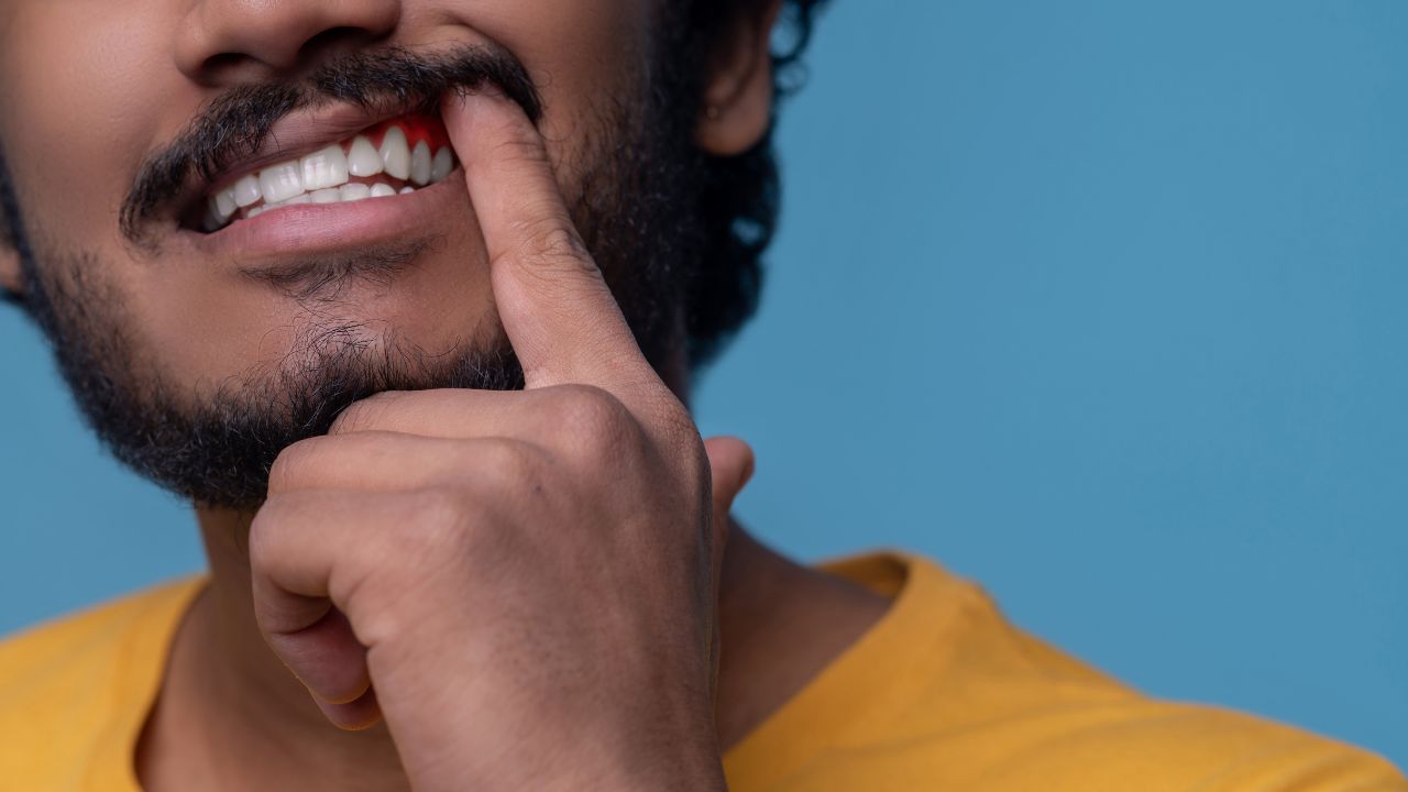 Gengivite e Periodontite