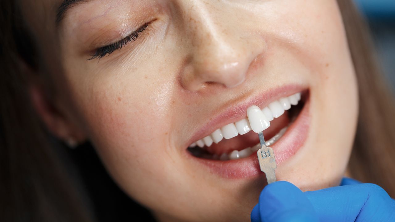 Quem não pode colocar lente de contato dental Quem não pode colocar lente de contato dental