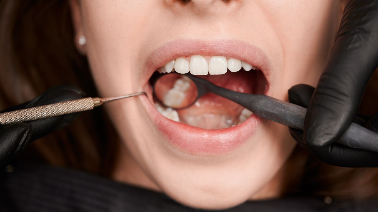 Como Prevenir a Placa Bacteriana