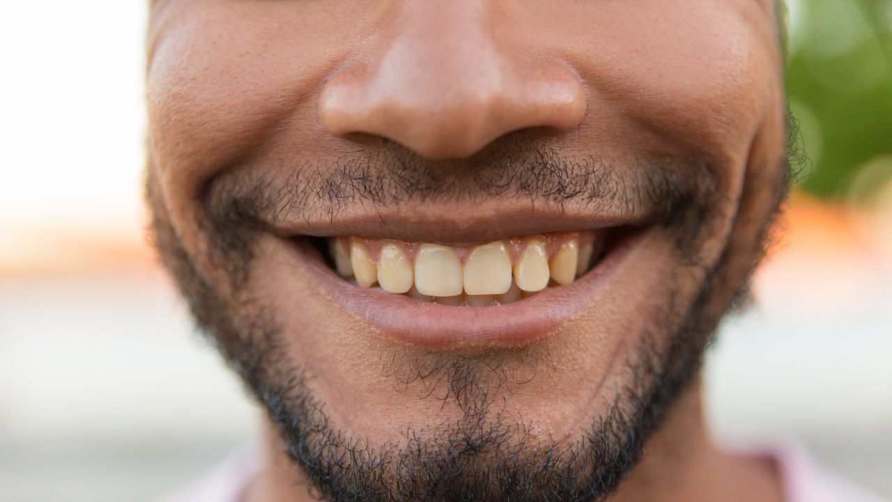 Dente amarelado
